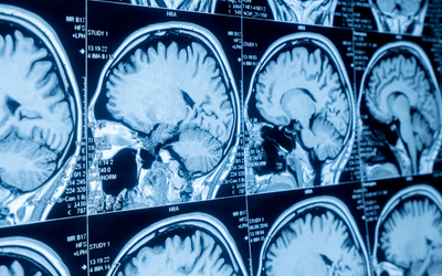 Autism Research: Genetics, Brain Differences, and What It Means