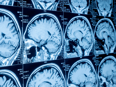 Autism Research: Genetics, Brain Differences, and What It Means